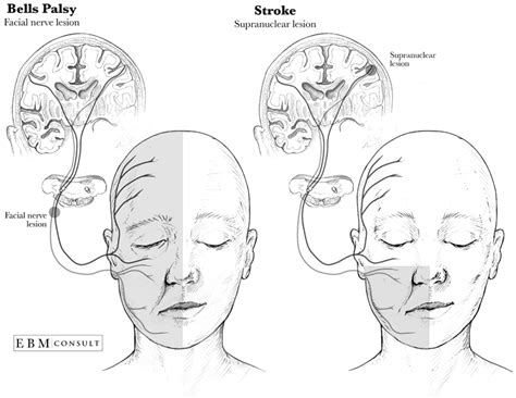 Bell's Palsy vs. Stroke | New Health Advisor