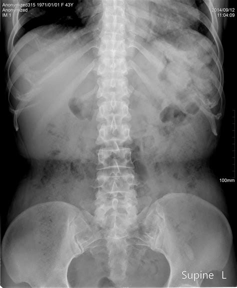 Supine Abdomen X Ray Anatomy