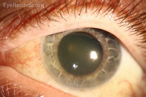 Atlas Entry - Corneal and lenticular pigmentation from long-term ...