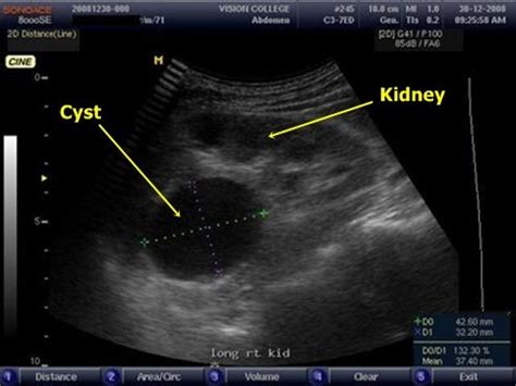 48 best images about Kidney Cyst on Pinterest | Cyst on kidney, Kidney disease and Dialysis