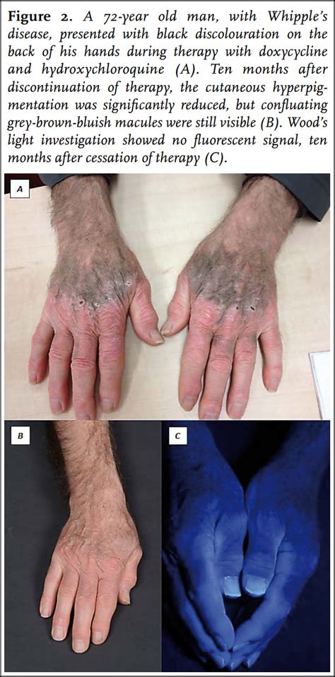 Article: Cutaneous hyperpigmentation induced by doxycycline: a case ...