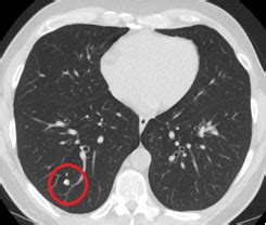 CT scans lower lung cancer deaths, according to study