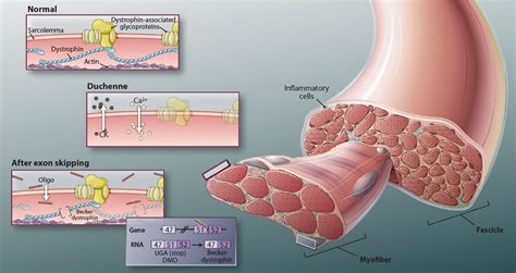 Exon-Skipping Therapy: A Roadblock, Detour, or Bump in the Road? | Science Translational Medicine