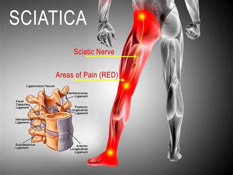 Is your sciatica bothering you? - We know how to solve it! - Ad Sacrum