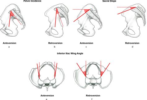 Lower pelvic tilt, lower pelvic incidence, and increased external rotation of the iliac wing in ...