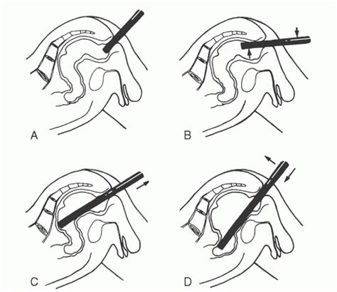 Anoscopy and Rigid Sigmoidoscopy | Abdominal Key