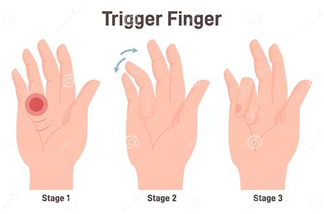 Trigger Finger or Finger Lock. Disease Causing Pain, Stiffness, and a ...