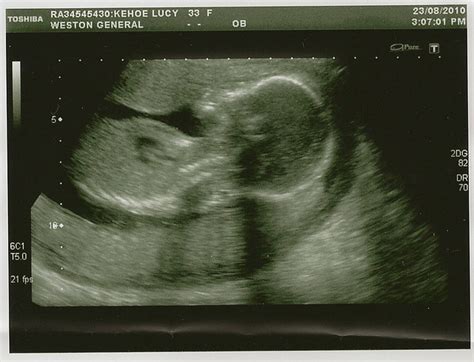 Baby Scan 20 Weeks #1 | Flickr - Photo Sharing!