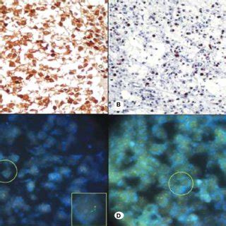 A) Anaplastic oligodendroglioma with positive immunoreaction with... | Download Scientific Diagram