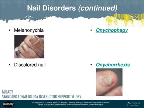 PPT - Chapter 10 Nail Disorders and Diseases PowerPoint Presentation, free download - ID:1076373