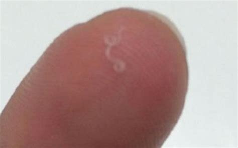 Worms plucked from woman's eye make medical history