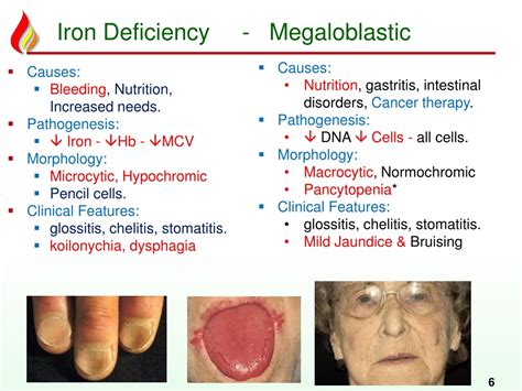 PPT - Haem12: Deficiency anemias PowerPoint Presentation, free download ...