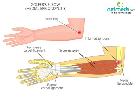 Golf Elbow Exercises | EOUA Blog