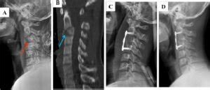 Anterior Cervical Corpectomy Spine Surgery Price in India - Best Hospitals in India