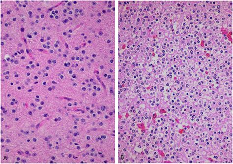 Irresti: Corticobasal Degeneration Pathology