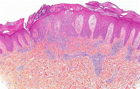 Skin biopsy from the left elbow (papule). Skin biopsy showed a subacute... | Download Scientific ...