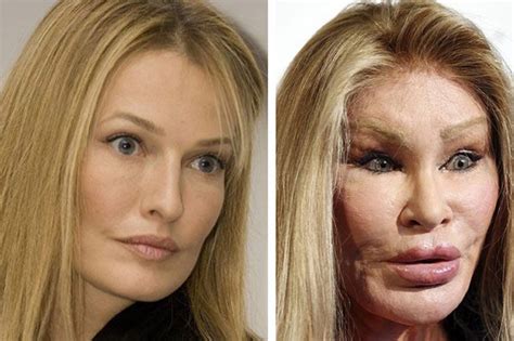 10 Celebs Who Ruined Their Faces Through Plastic Surgery | ewmoda