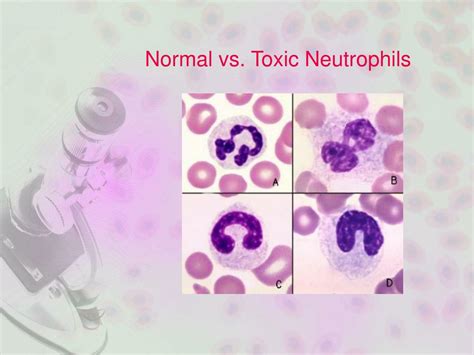 Toxic Granulation Vs Normal Neutrophil