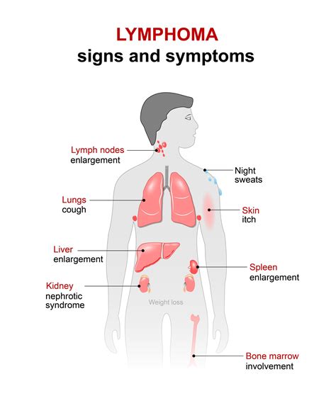 Getting Long-Term Disability (LTD) Benefits for Lymphoma | CCK Law