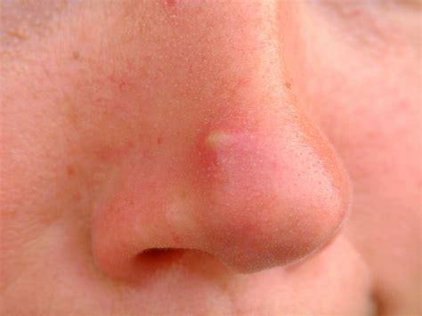 Nose acne: Causes, treatment, and remedies