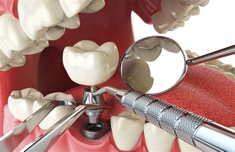 DENTAL IMPLANTS PROCEDURE - Dr Paulo Pinho