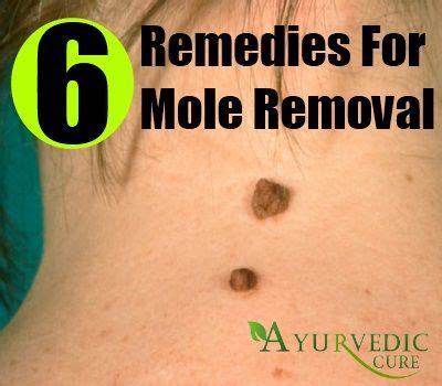 6 Home Remedies For Mole Removal | Mole removal, Home remedies for skin, Mole