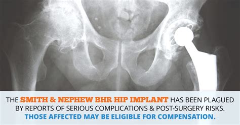 Smith & Nephew BHR Hip Implant Lawsuits // Consumer Safety Watch - Consumer Safety Watch