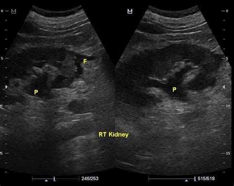 Extrarenal Pelvis Ultrasound