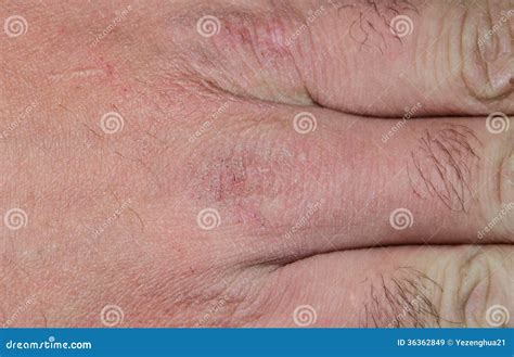 Hand Dry Cracked Skin in the Winter Stock Image - Image of foot, herpes ...