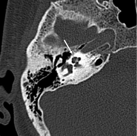 Petrous Temporal Bone Fracture