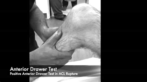 MRCS Knee Examination: Positive Anterior Drawer - YouTube