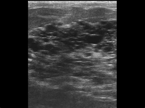 Breast and Axilla | 5.1 Benign lesions : Case 5.1.5 Galactoceles and sebaceous cysts ...