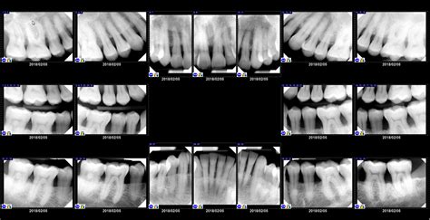 Dental X Rays Cut Mouth at Jamie Harris blog