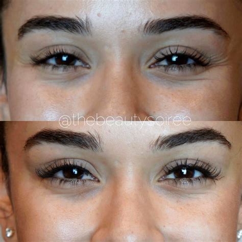 Botox Brow Lift Before And After Pictures » Eyelid Surgery: Cost ...