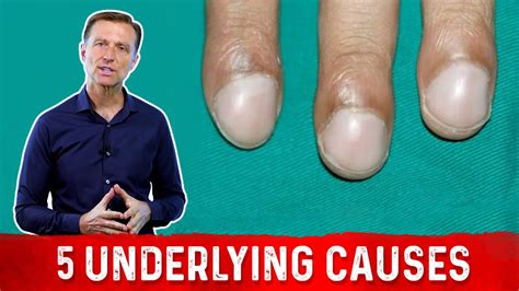 What Causes Clubbing of the Nail? | clubbing finger คือ - CASTU