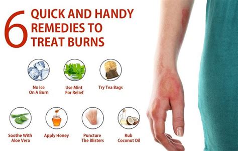 Home Remedies To Treat Burns | Dafcuk | Treat burns, Remedies, Home ...