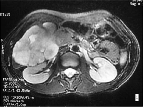 MRI imaging. In the right hepatic lobe a lesion of 9.6 × 8.9 × 7.9 cm 3... | Download Scientific ...