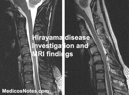 Hirayama Disease - Investigation and MRI findings