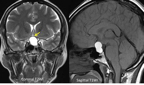 Pituitary apoplexy – Radiology Cases