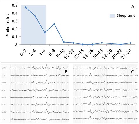 Generalized Seizure Eeg