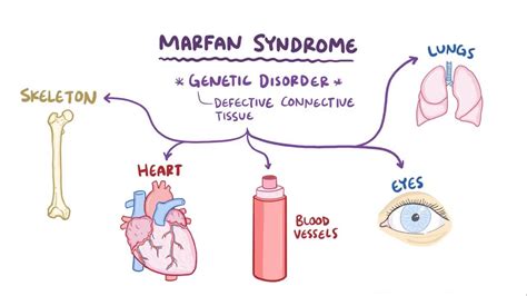 Marfan syndrome: Video, Anatomy, Definition & Function | Osmosis