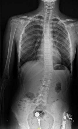 Scoliosis (PA/AP view) | Radiology Reference Article | Radiopaedia.org