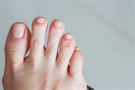 Causes Of White Spots On Your Toenails – My FootDr