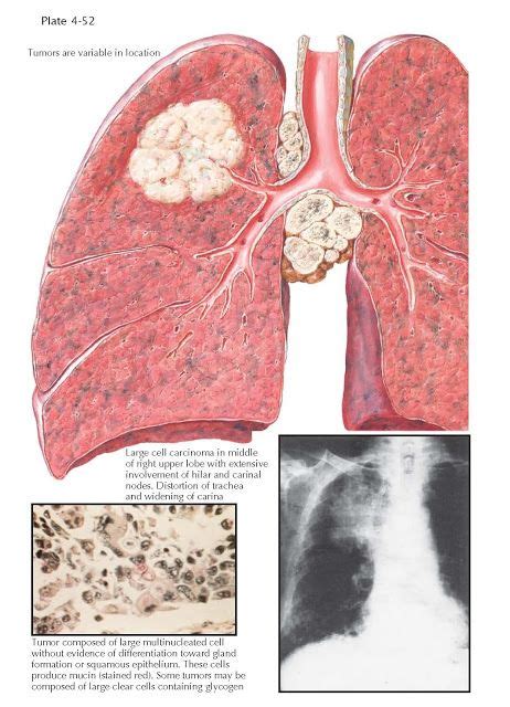 LARGE CELL CARCINOMAS OF THE LUNG | Medical wallpaper, Lunges, Iphone ...