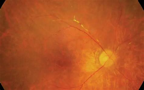 Autoimmune Retinopathy: Symptoms and Management | OBN