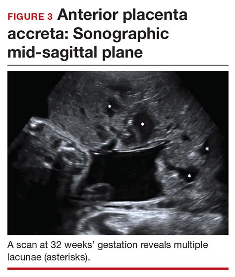 Diagnosing placenta accreta spectrum with prenatal ultrasound | MDedge ObGyn