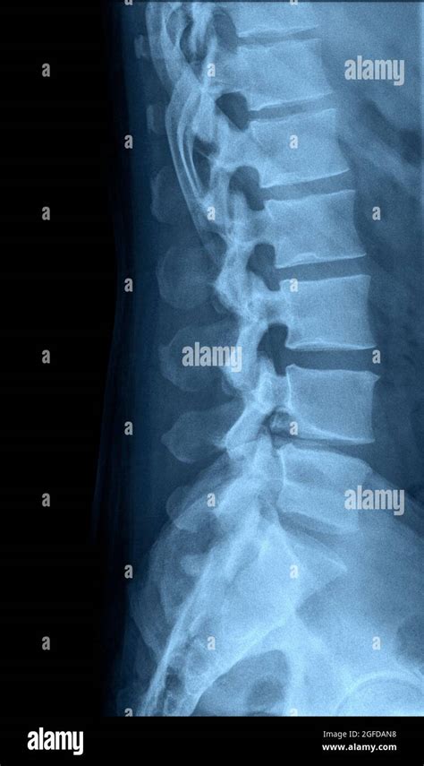 Anatomy of lumbar spine hi-res stock photography and images - Alamy