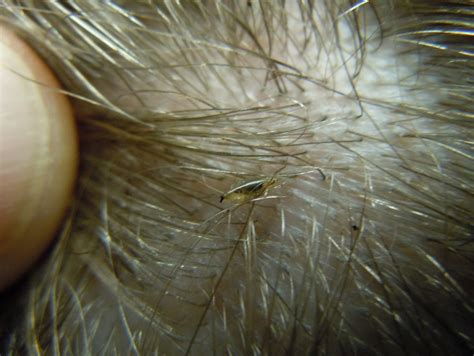 Lice Symptoms, Causes, Diagnosis and Treatment - Natural Health News