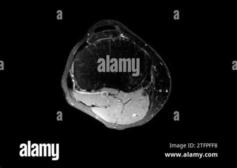 MRI knee joint. Dynamics of scrolling through MRI images. Magnetic ...