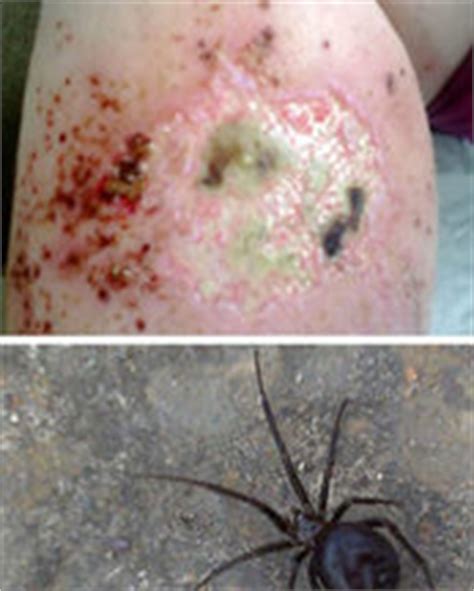 False Widow Spider Bite What To Do : The Horrific Effects Of The False Widow Spider Bite ...